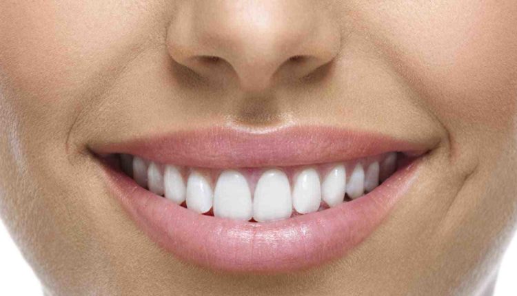 Are veneers worth it?