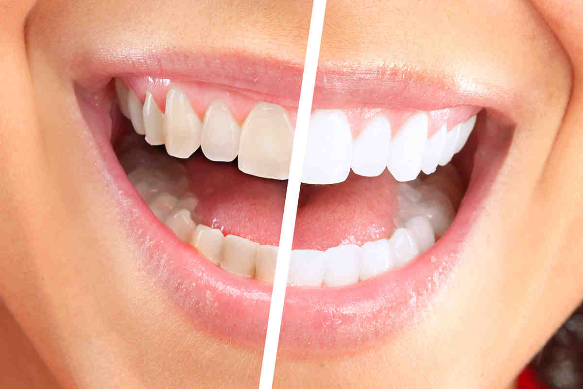 Are zirconia implants more expensive than titanium?