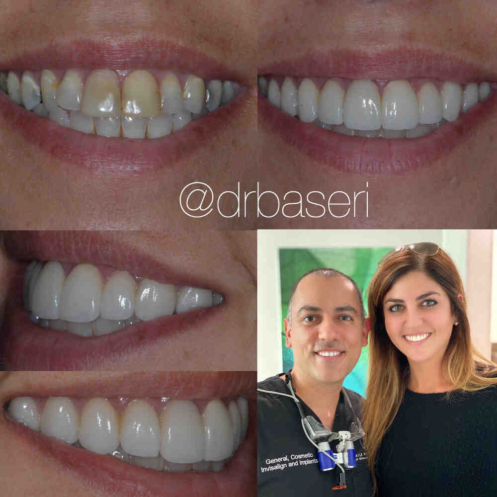Can I get braces for free?