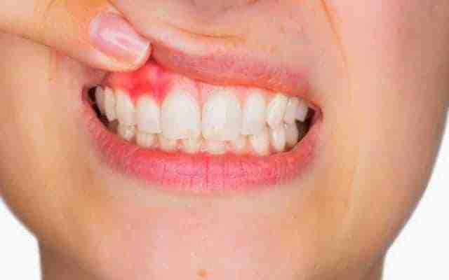 Can I have implants with receding gums?