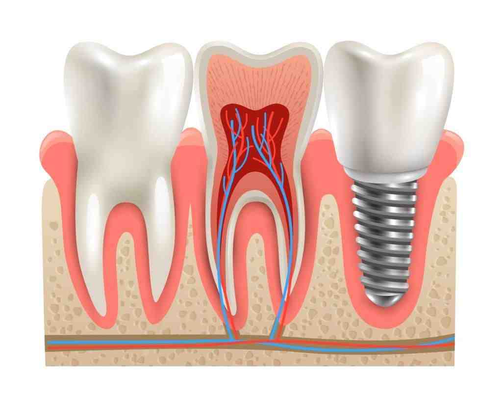 Can I just get a filling instead of a root canal?