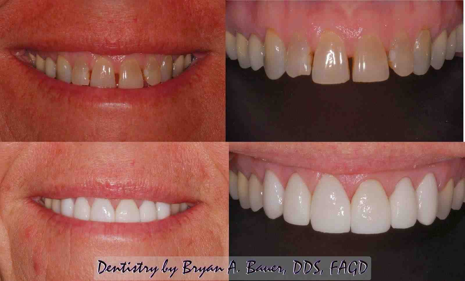 Can Invisalign fix tilted teeth?