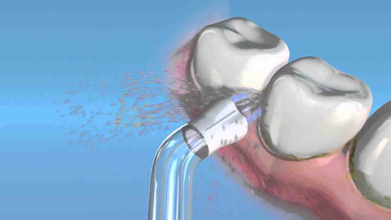 Are water piks damaging to dental implants Dental News Network