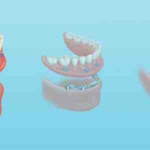 Can Waterpik damage implants?