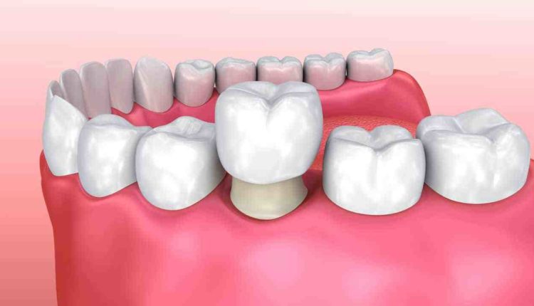 Can a dental implant be shaven