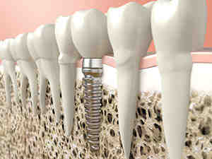 Can a dental implant get infected years later?