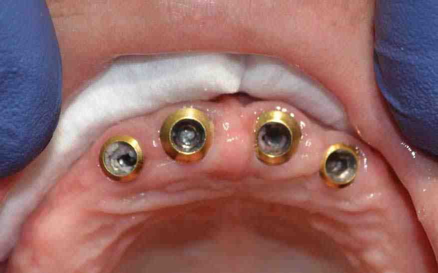 Can an abutment come loose?