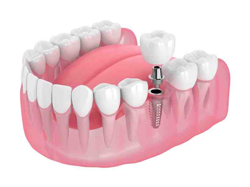 Can dental implants be removed and replaced?