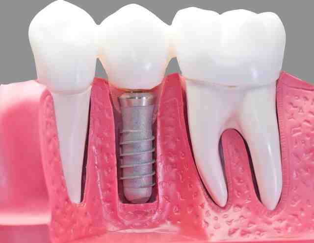 Can dental implants be taken out?