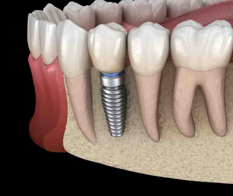 Can dental implants cause heart problems?