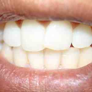 Can dental implants get infected years later?