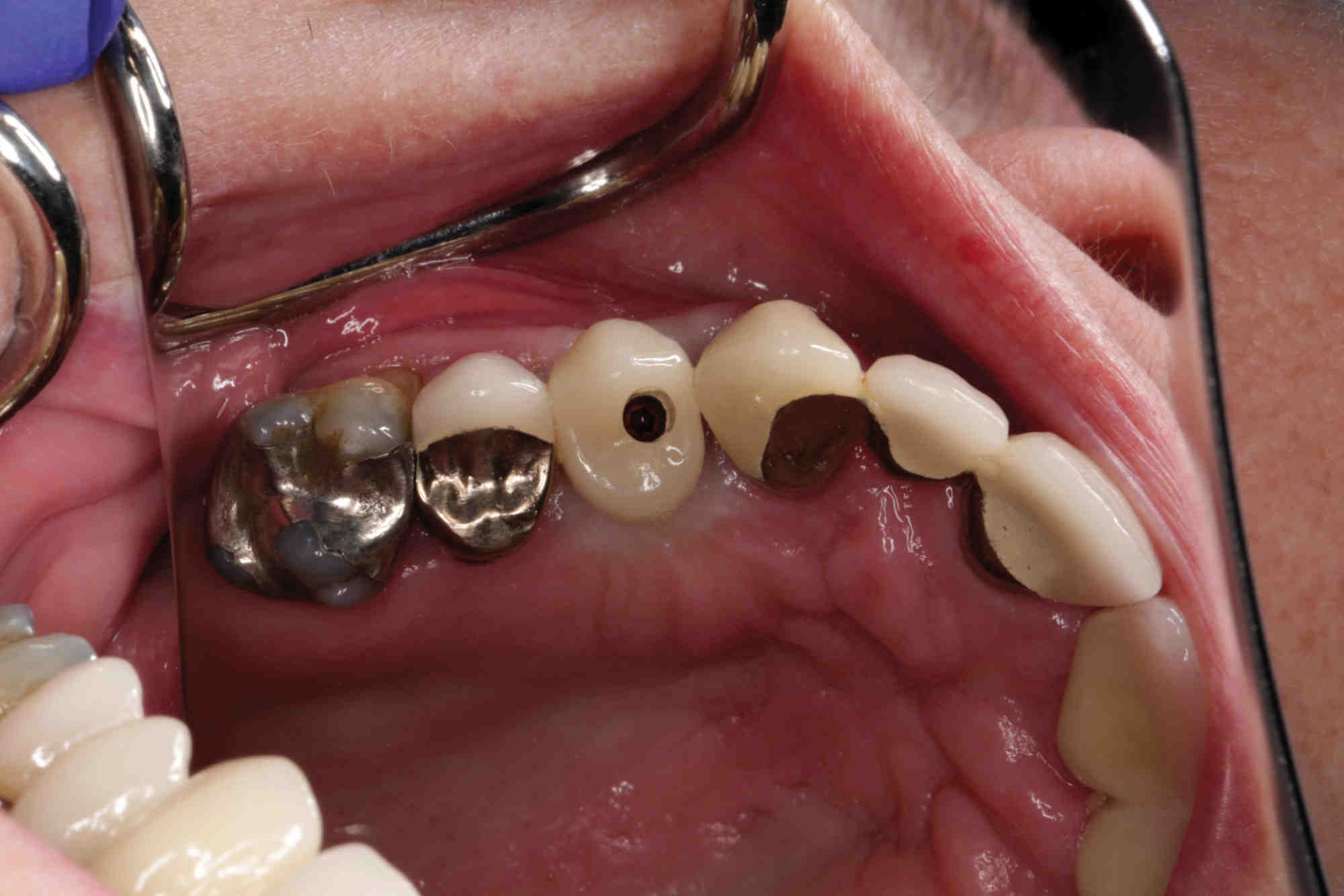 What should you do if a stitch from a dental implant comes loose