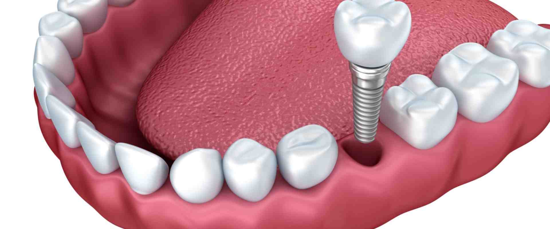 Can failed dental implants be replaced?
