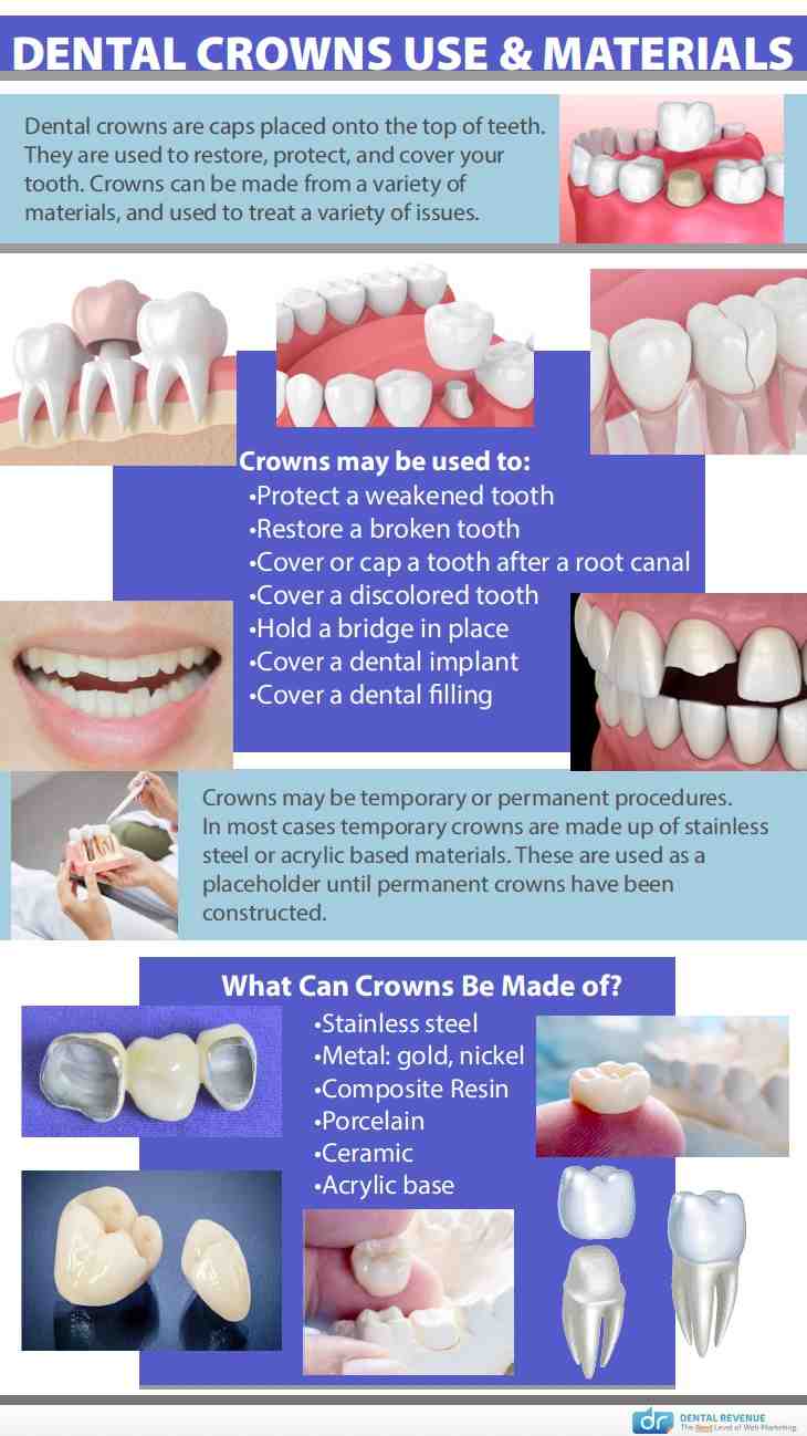 Can food get under dental implants?