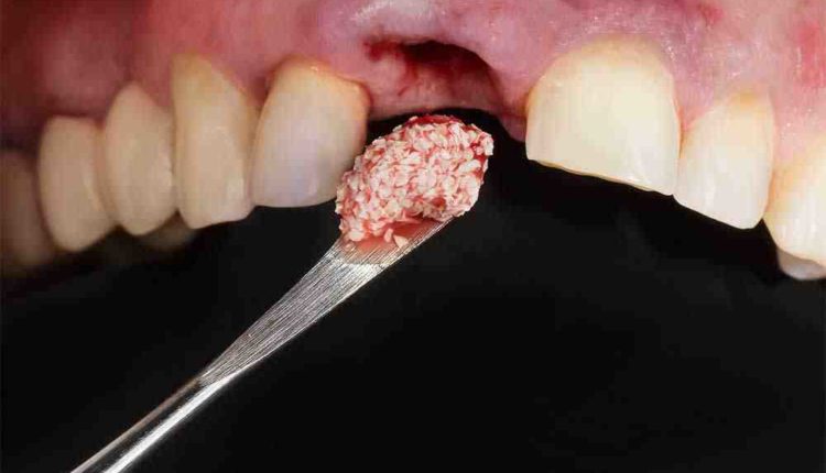 Can people with no bone get dental implants