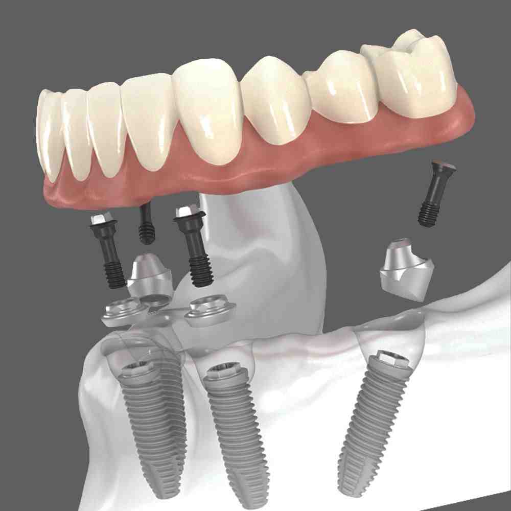 What To Expect With All-on-4 Dental Implants - Dental News Network