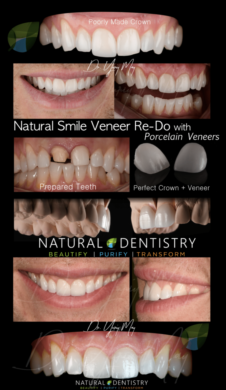 How many times can you redo veneers? Dental News Network