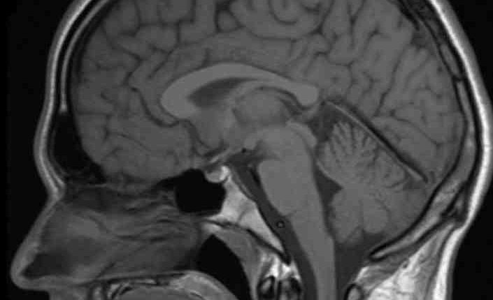 Can u have mri with dental implants