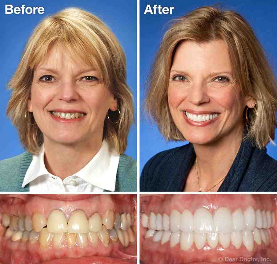 Can veneers get loose?
