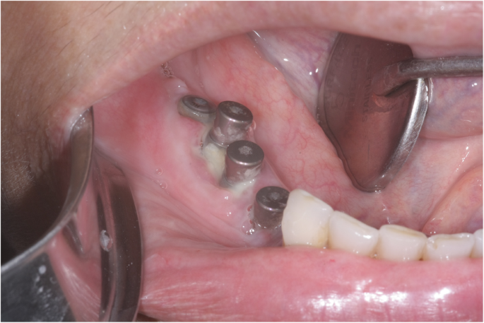 Can you do implant right after extraction?