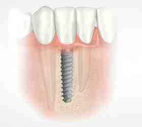 Can you get a temporary tooth while waiting for an implant?