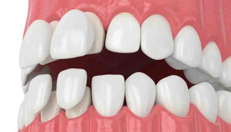 Can you get cavities if you have veneers?