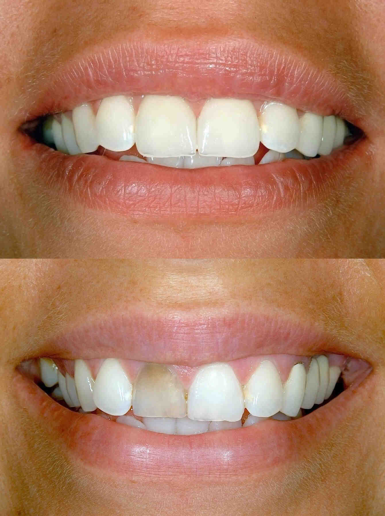 How long does it take to put veneers on? Dental News Network