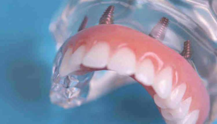 Can you get dental implants after dentures