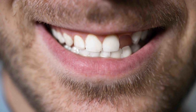 Can you get dental implants with no teeth