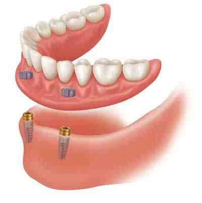 Can you have too much bone loss for dentures?
