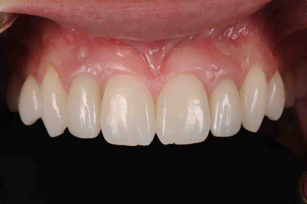 Can you tell the difference between real teeth and implants?
