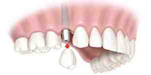 Can your mouth reject a tooth implant?