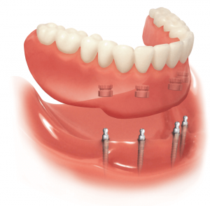 Can your mouth reject an implant?