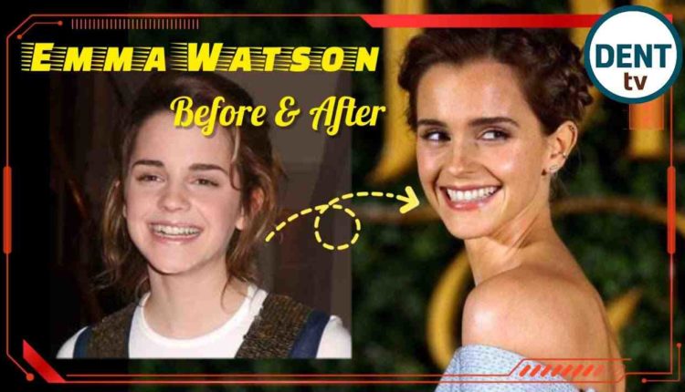 Did selena gomez get dental implants