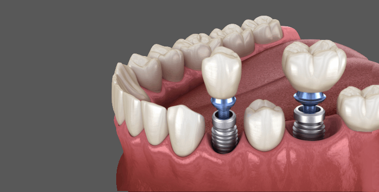 Do dental implants cause cancer