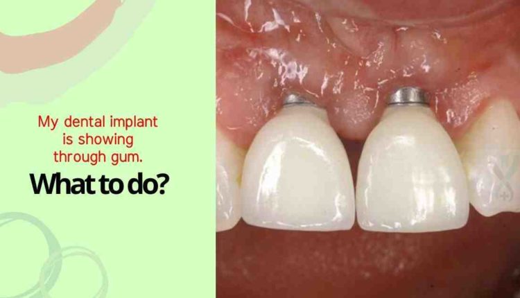 Do dental implants have fake gums