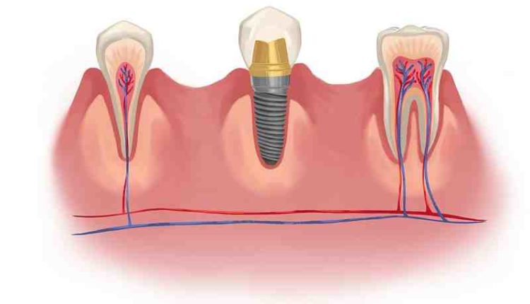 Do dental work and implants is tax deduction