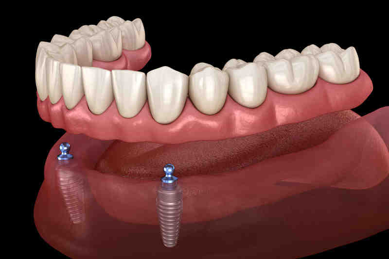 Do electric toothbrushes loosen implants?
