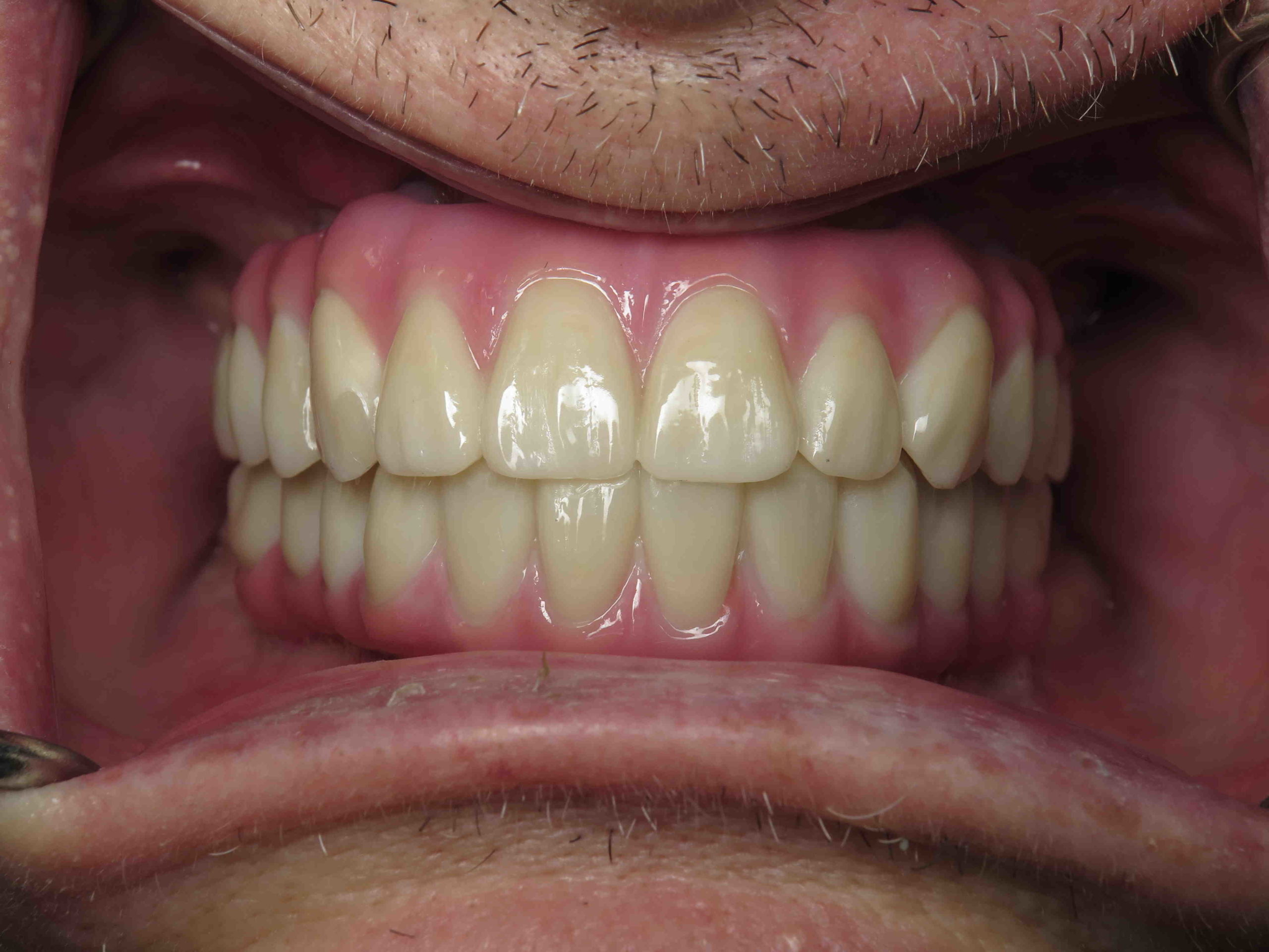 Do implant supported dentures have to be removed at night?
