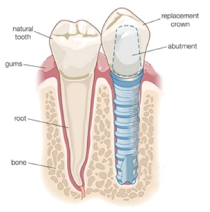 Do implants make you look younger?