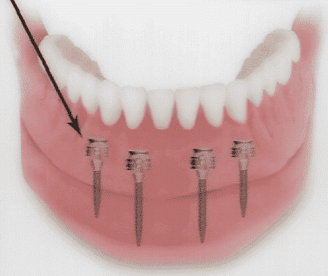 Do mini implants prevent bone loss?