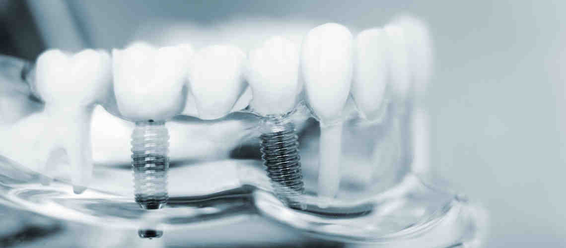 Do mini implants work in upper jaw?