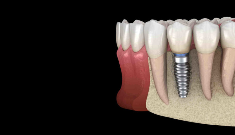 Do most dental implants need bone graft?