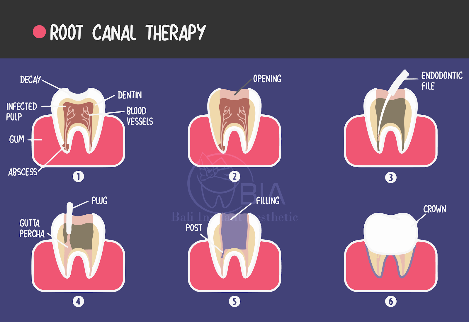 Do they put you to sleep for full dental implants?