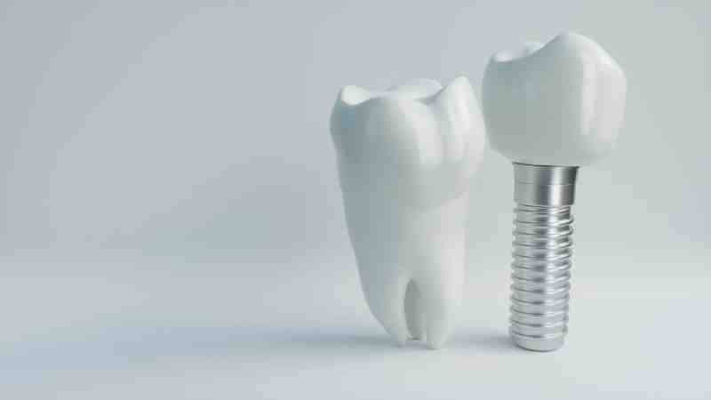 Do they put you to sleep when you get dental implants?