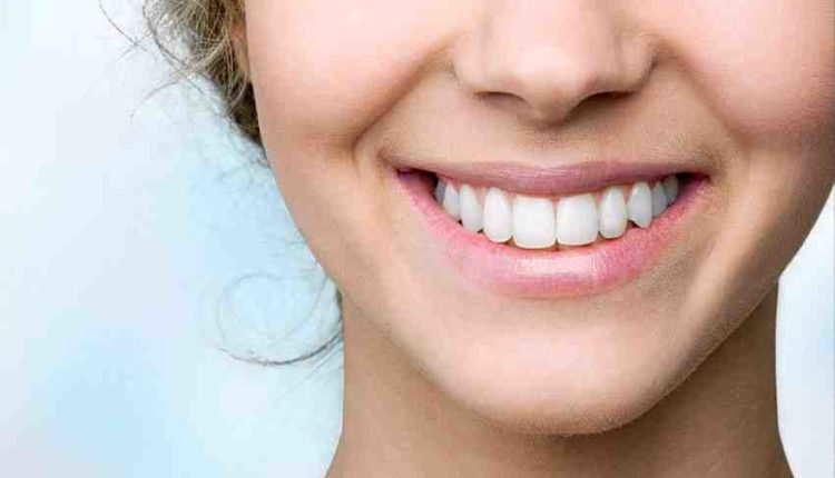 Do they shave your teeth for veneers?