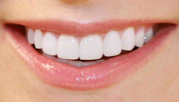 Do veneers fall off?