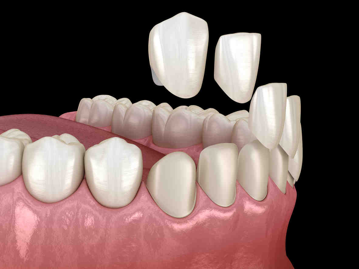 Do veneers feel like normal teeth?