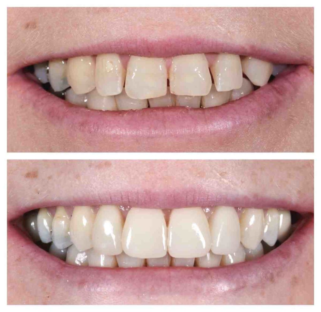 Are veneers painful? Dental News Network