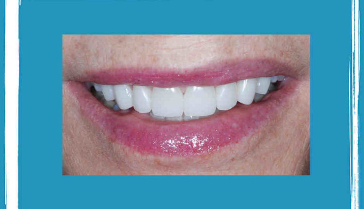 Do veneers last a lifetime?